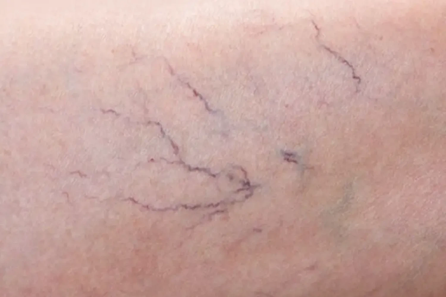 BESENREISER, ROSACEA, SPIDER NAEVI UVM. von Laserästhetik Berlin