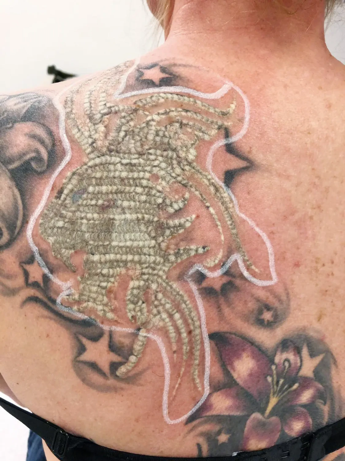 Tattooentfernung von Laserästhetik Berlin