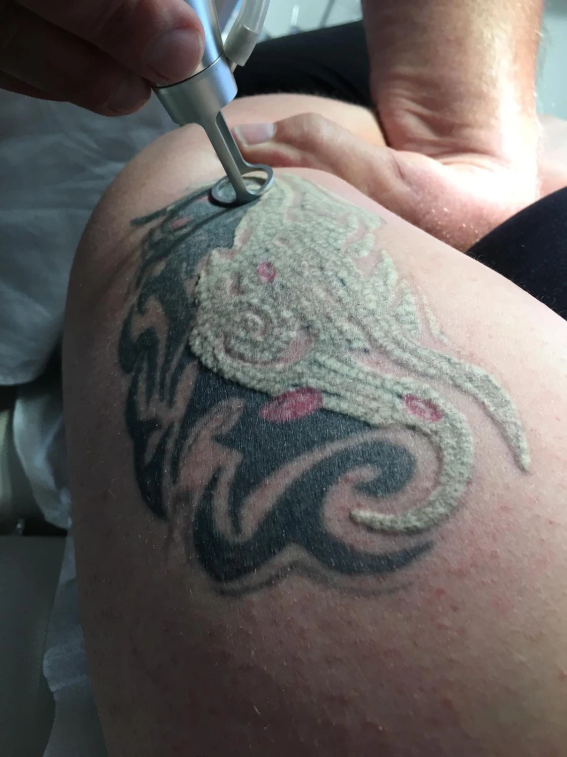 Tattooentfernung von Laserästhetik Berlin