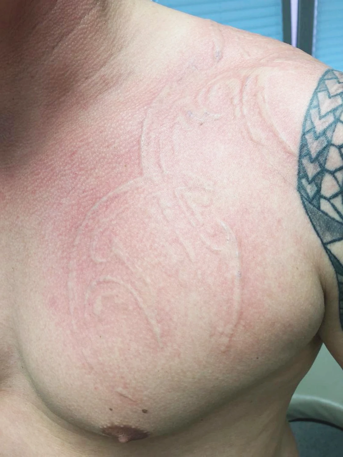 Tattooentfernung von Laserästhetik Berlin