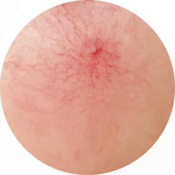 Blutgefäße (Vaskuläre Läsionen) von Laserästhetik Berlin