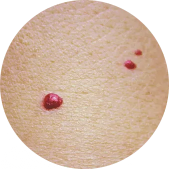 Blutgefäße (Vaskuläre Läsionen) von Laserästhetik Berlin
