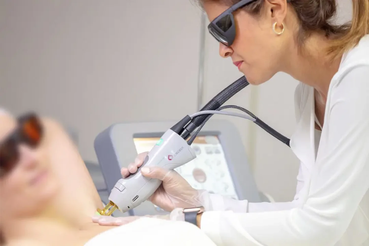 Elos Epilation – Haarentfernung im Gesicht einer Frau.